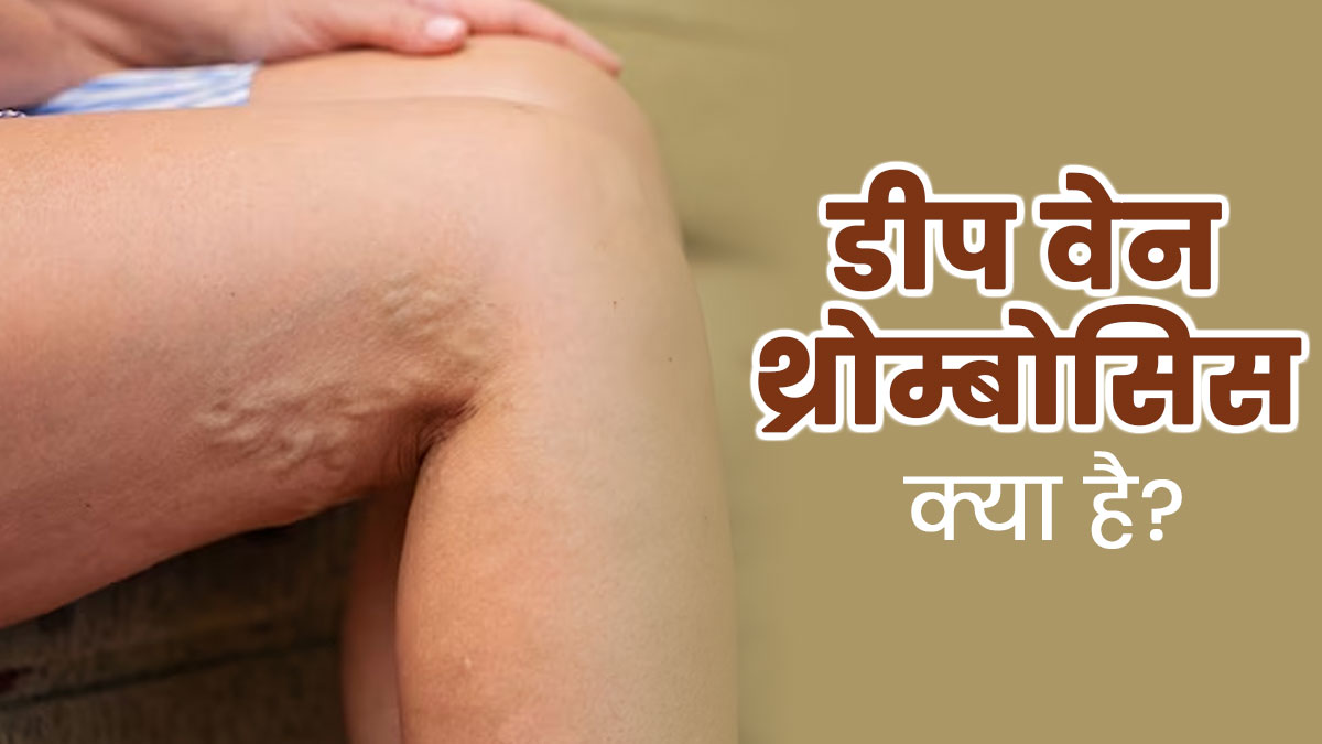डीप वेन थ्रोम्बोसिस (एक नस में रक्त का थक्का बनना) क्या है? जानें इसके लक्षण और बचाव के तरीके